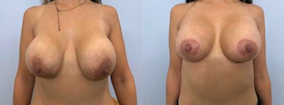 Breast Revision Before & After Gallery - Patient 47146948 - Image 1