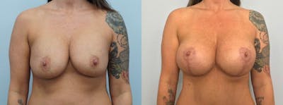 Breast Revision Before & After Gallery - Patient 47146949 - Image 1