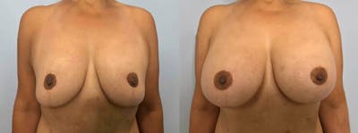 Breast Revision Before & After Gallery - Patient 47146950 - Image 1