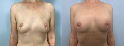 Breast Revision Before & After Gallery - Patient 47146951 - Image 1