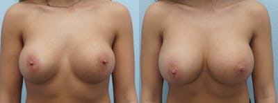 Breast Revision Before & After Gallery - Patient 47146952 - Image 1