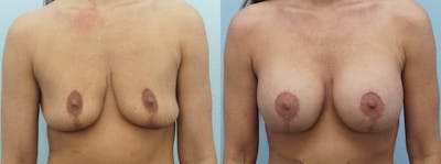 Breast Revision Before & After Gallery - Patient 47146953 - Image 1