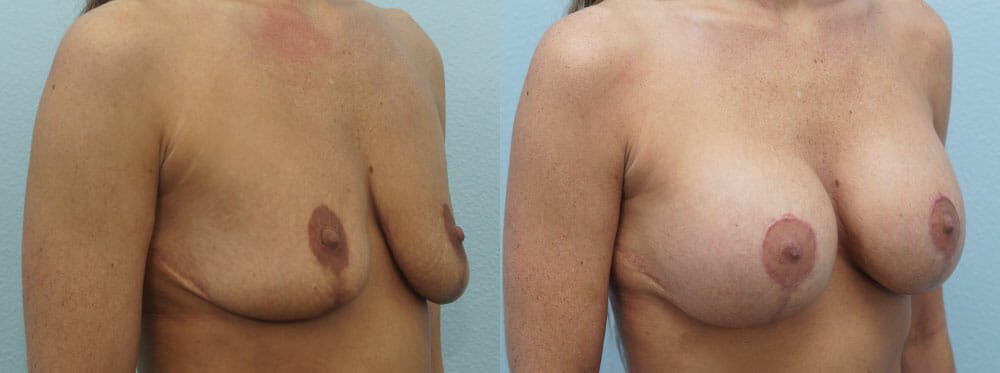 Breast Revision Gallery - Patient 47146953 - Image 4