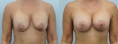 Breast Revision Before & After Gallery - Patient 47146954 - Image 1