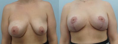 Breast Revision Before & After Gallery - Patient 47146956 - Image 1