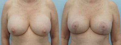 Breast Revision Before & After Gallery - Patient 47146986 - Image 1