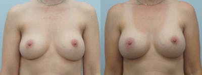 Breast Revision Before & After Gallery - Patient 47147030 - Image 1