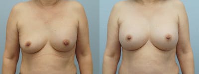 Breast Revision Before & After Gallery - Patient 47147041 - Image 1