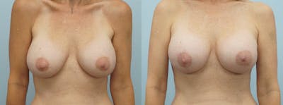 Breast Revision Before & After Gallery - Patient 47147048 - Image 1