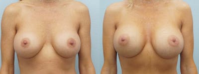 Breast Revision Before & After Gallery - Patient 47147061 - Image 1