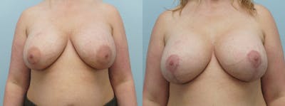Breast Revision Before & After Gallery - Patient 47147068 - Image 1