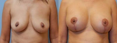 Breast Revision Before & After Gallery - Patient 47147081 - Image 1
