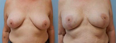 Breast Revision Before & After Gallery - Patient 47147113 - Image 1