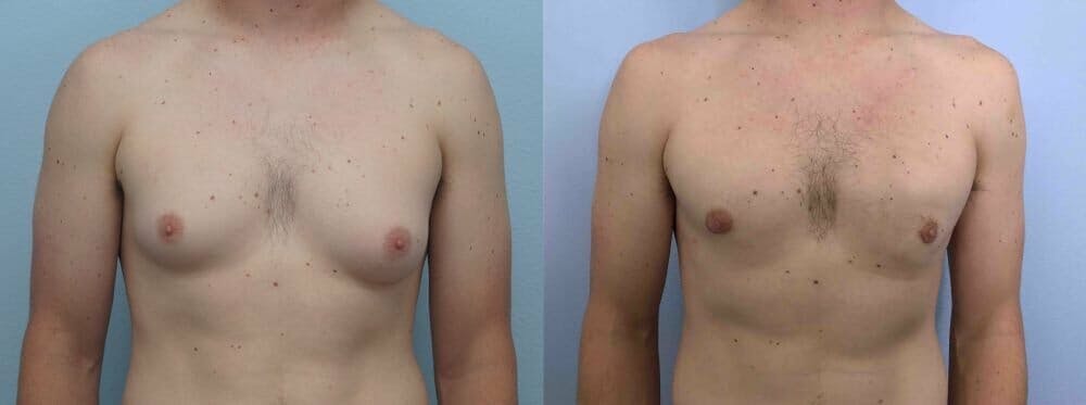 Gynecomastia