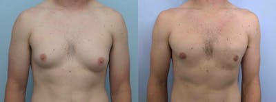 Gynecomastia Repair Before & After Gallery - Patient 53582538 - Image 1