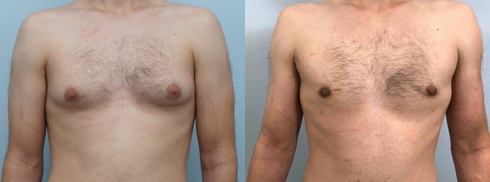 Gynecomastia