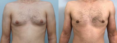 Gynecomastia Repair Before & After Gallery - Patient 47147535 - Image 1