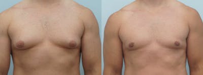 Gynecomastia Repair Before & After Gallery - Patient 53582540 - Image 1