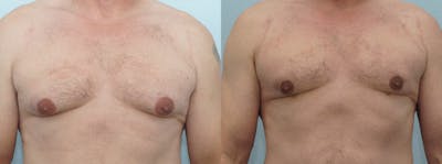 Gynecomastia Repair Before & After Gallery - Patient 53582541 - Image 1