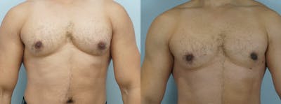 Gynecomastia Repair Before & After Gallery - Patient 47147646 - Image 1