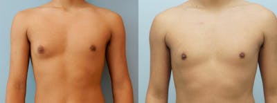 Gynecomastia Repair Before & After Gallery - Patient 47147690 - Image 1