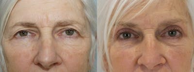 Eyelid Surgery Before & After Gallery - Patient 53582628 - Image 1