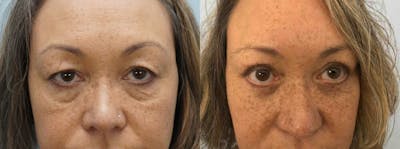 Eyelid Surgery Gallery - Patient 53582629 - Image 1