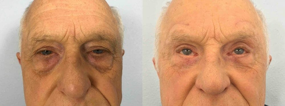 Eyelid Surgery
