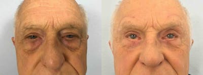 Eyelid Surgery Before & After Gallery - Patient 53582630 - Image 1