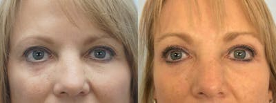 Eyelid Surgery Before & After Gallery - Patient 53582632 - Image 1