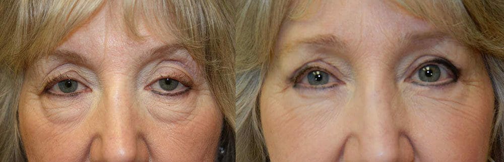 Eyelid Surgery Gallery - Patient 53582633 - Image 1