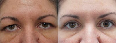 Eyelid Surgery Gallery - Patient 53582634 - Image 1