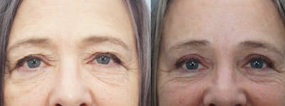 Eyelid Surgery Before & After Gallery - Patient 53582635 - Image 1