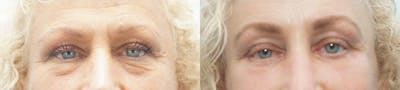 Eyelid Surgery Before & After Gallery - Patient 53582636 - Image 1