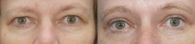 Eyelid Surgery Before & After Gallery - Patient 53582637 - Image 1