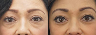 Eyelid Surgery Before & After Gallery - Patient 53582638 - Image 1