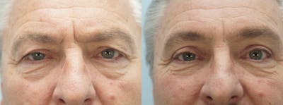Eyelid Surgery Before & After Gallery - Patient 53582639 - Image 1