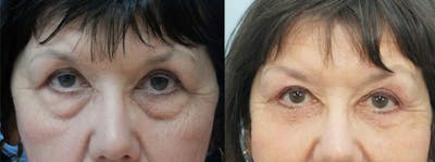 Eyelid Surgery Before & After Gallery - Patient 53582641 - Image 1