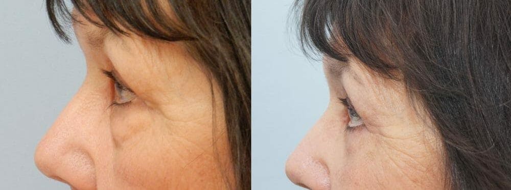 Eyelid Surgery Gallery - Patient 53582641 - Image 2