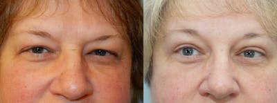 Eyelid Surgery Before & After Gallery - Patient 53582644 - Image 1