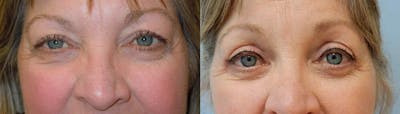 Eyelid Surgery Before & After Gallery - Patient 53582647 - Image 1