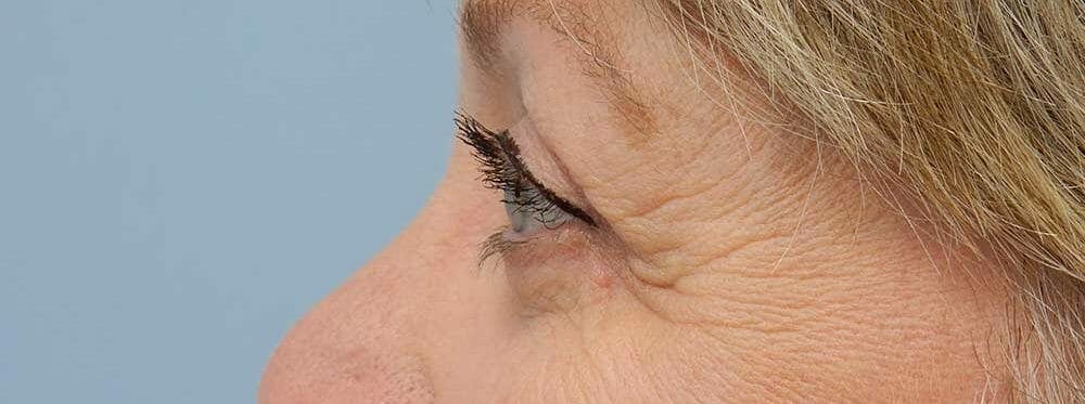 Eyelid Surgery Gallery - Patient 53582647 - Image 3