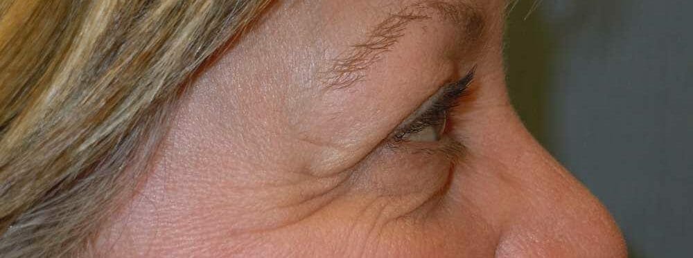 Eyelid Surgery Gallery - Patient 53582647 - Image 4