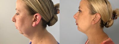 Chin Augmentation Before & After Gallery - Patient 47148539 - Image 1