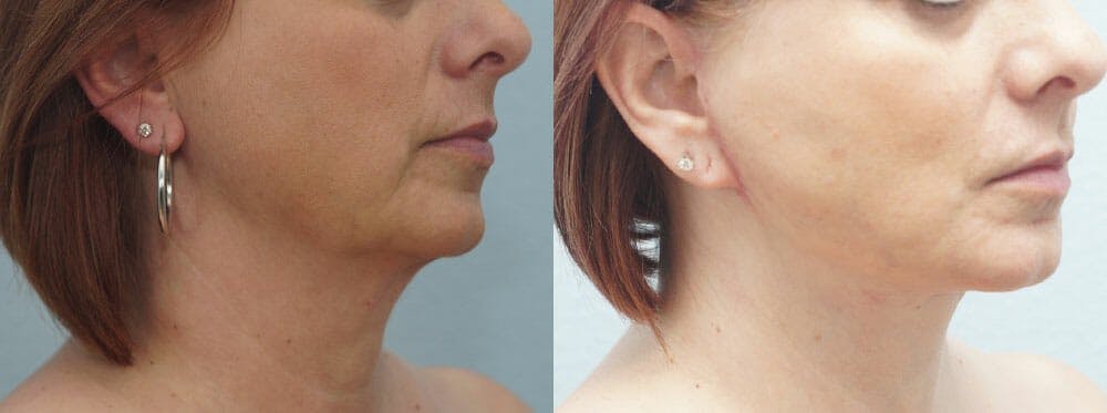 Facial Liposuction Gallery - Patient 47148562 - Image 3