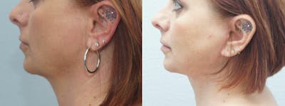Facial Liposuction Before & After Gallery - Patient 47148562 - Image 1