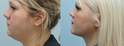 Facial Liposuction Before & After Gallery - Patient 47148563 - Image 1