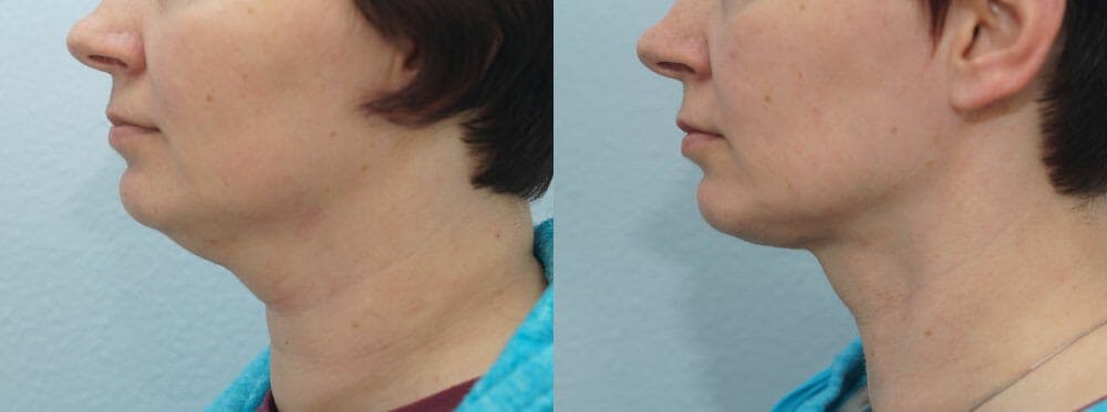 Facial Liposuction Gallery - Patient 47148564 - Image 1