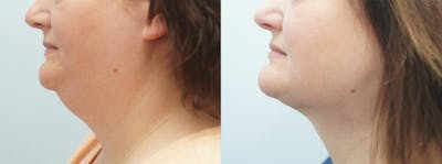 Facial Liposuction Before & After Gallery - Patient 47148565 - Image 1