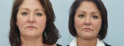 Facelift Surgery Before & After Gallery - Patient 47149497 - Image 1